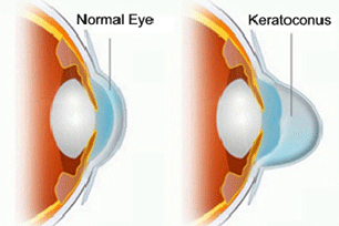 remove glasses