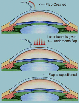 remove glasses